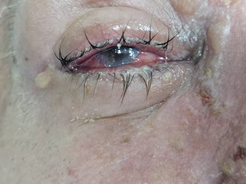 Herpes zoster oftálmico